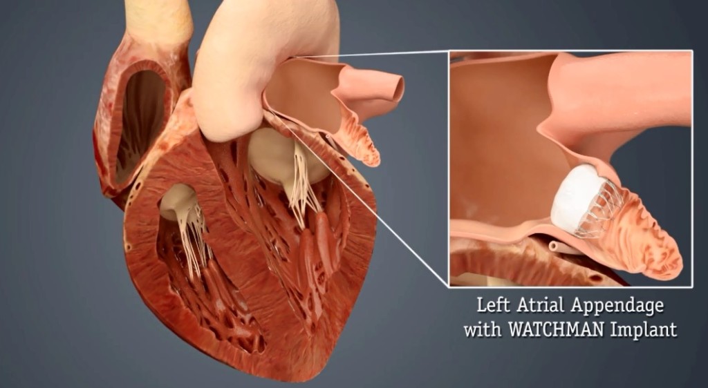 Heart Hospital First in State to Offer Watchman Heart Implant