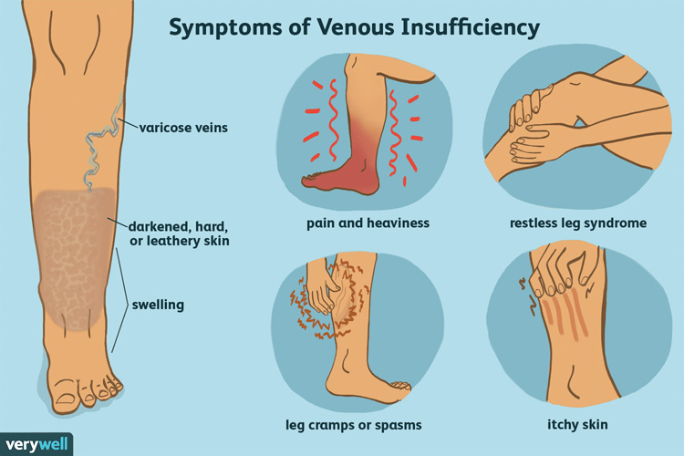 Chronic Venous Insufficiency (CVI), Department of Surgery